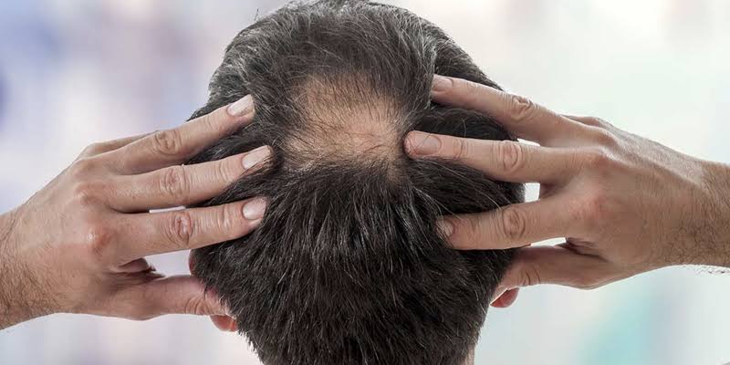 Saç Dökülmesi ve Biotin İlişkisi